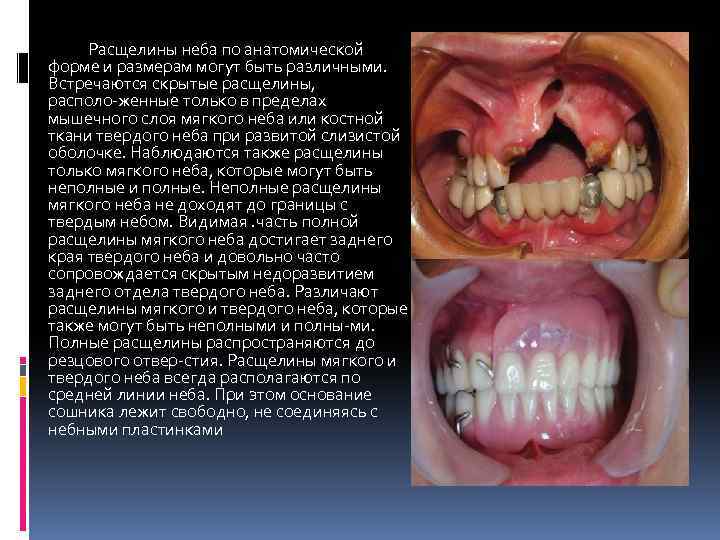 Расщелины неба по анатомической форме и размерам могут быть различными. Встречаются скрытые расщелины, располо