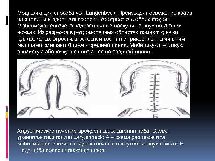 Модификация способа von Langenbeck. Производят освежение краев расщелины и вдоль альвеолярного отростка с обеих