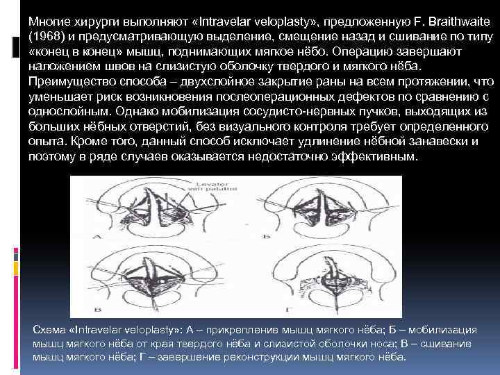 Многие хирурги выполняют «Intravelar veloplasty» , предложенную F. Braithwaite (1968) и предусматривающую выделение, смещение