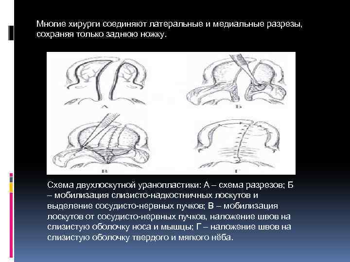 Многие хирурги соединяют латеральные и медиальные разрезы, сохраняя только заднюю ножку. Схема двухлоскутной уранопластики: