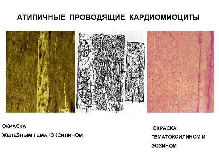 АТИПИЧНЫЕ ПРОВОДЯЩИЕ КАРДИОМИОЦИТЫ ОКРАСКА ЖЕЛЕЗНЫМ ГЕМАТОКСИЛИНОМ И ЭОЗИНОМ 