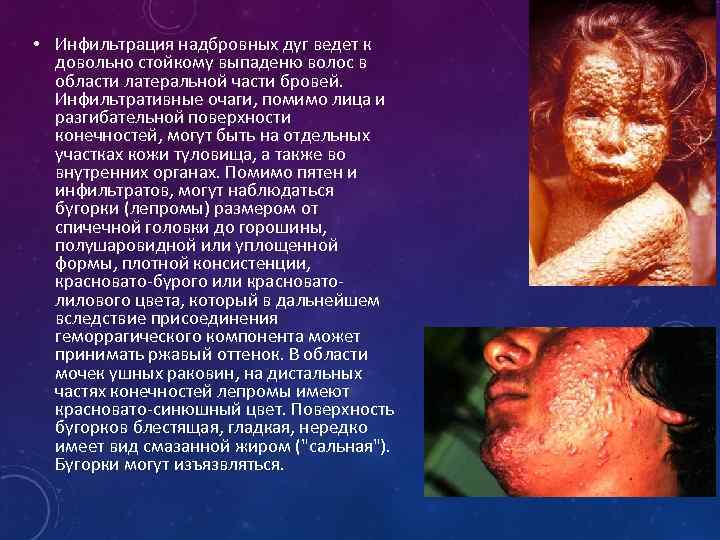  • Инфильтрация надбровных дуг ведет к довольно стойкому выпаденю волос в области латеральной