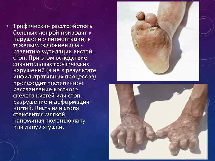  • Трофические расстройства у больных лепрой приводят к нарушению пигментации, к тяжелым осложнениям