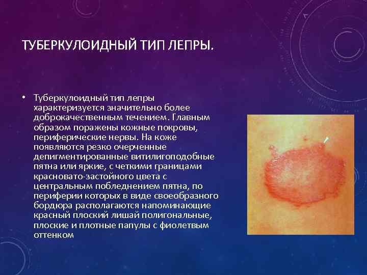 ТУБЕРКУЛОИДНЫЙ ТИП ЛЕПРЫ. • Туберкулоидный тип лепры характеризуется значительно более доброкачественным течением. Главным образом