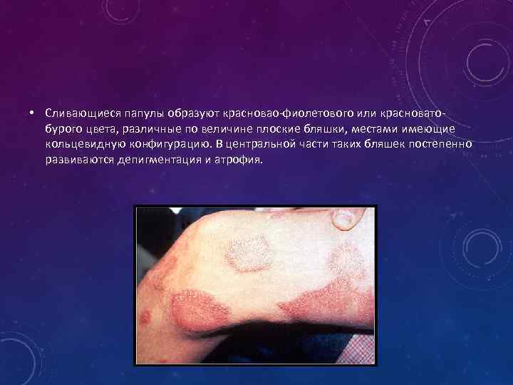  • Сливающиеся папулы образуют красновао-фиолетового или красноватобурого цвета, различные по величине плоские бляшки,