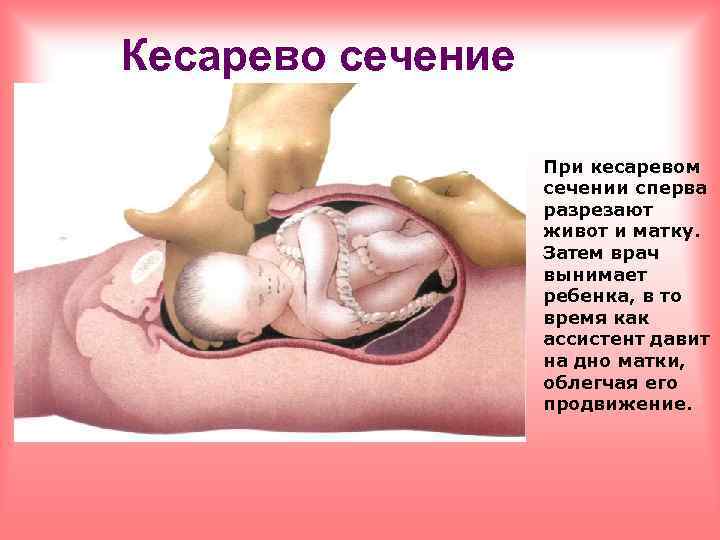 Кесарево сечение При кесаревом сечении сперва разрезают живот и матку. Затем врач вынимает ребенка,