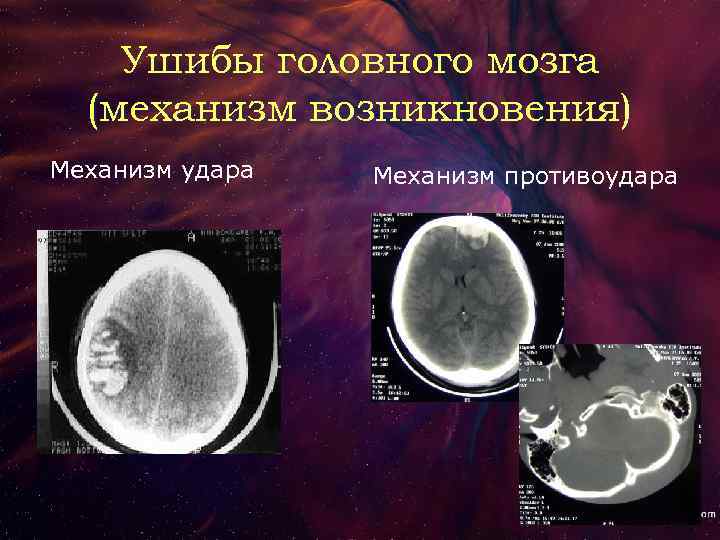 Ушибы головного мозга (механизм возникновения) Механизм удара Механизм противоудара 