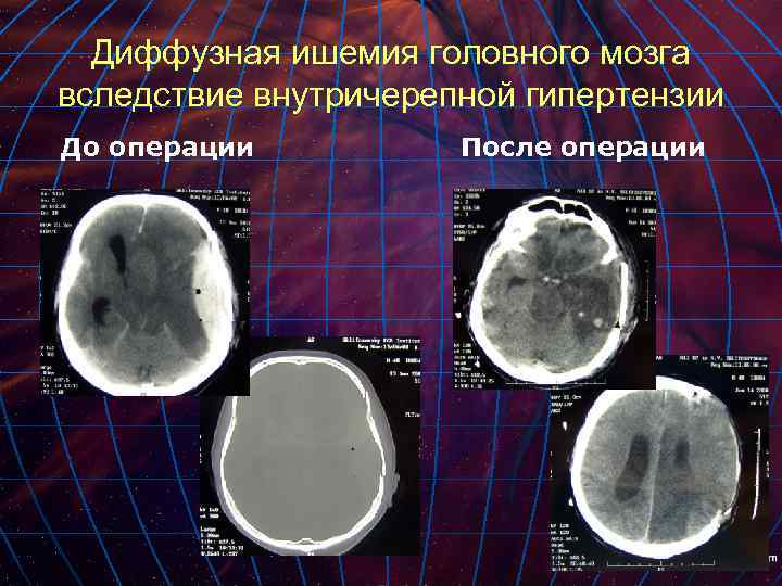 Диффузная ишемия головного мозга вследствие внутричерепной гипертензии До операции После операции 