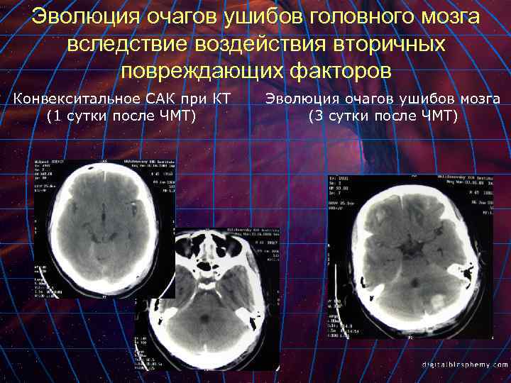 Эволюция очагов ушибов головного мозга вследствие воздействия вторичных повреждающих факторов Конвекситальное САК при КТ