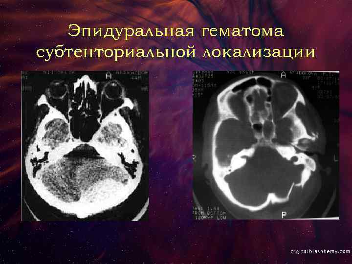 Эпидуральная гематома субтенториальной локализации 