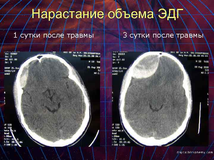 Нарастание объема ЭДГ 1 сутки после травмы 3 сутки после травмы 