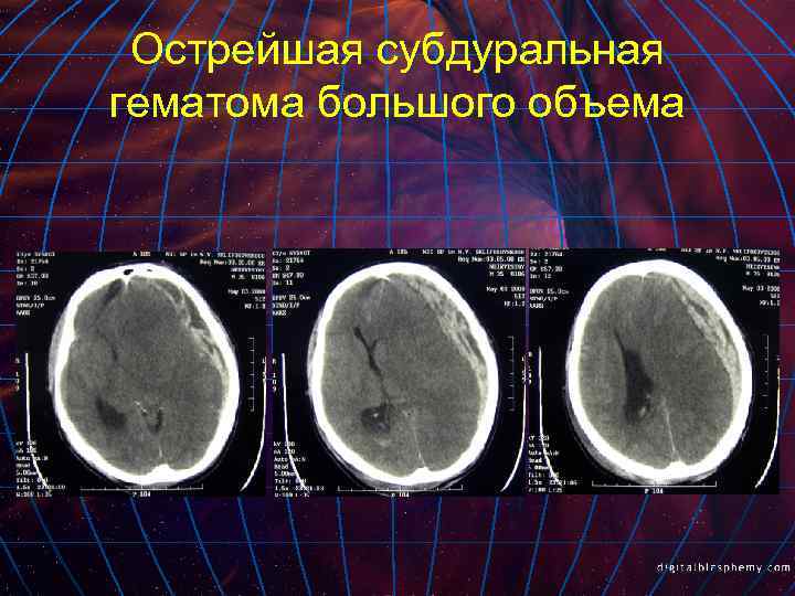 Острейшая субдуральная гематома большого объема 