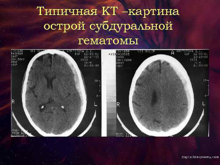 Типичная КТ –картина острой субдуральной гематомы 