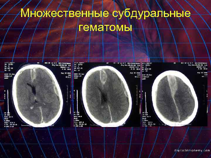 Множественные субдуральные гематомы 