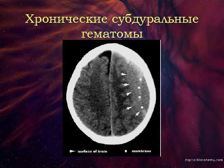 Хронические субдуральные гематомы 