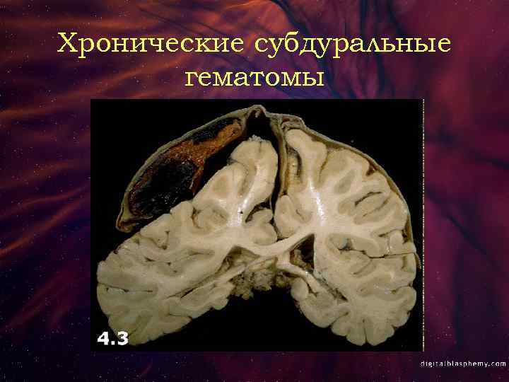 Хронические субдуральные гематомы 