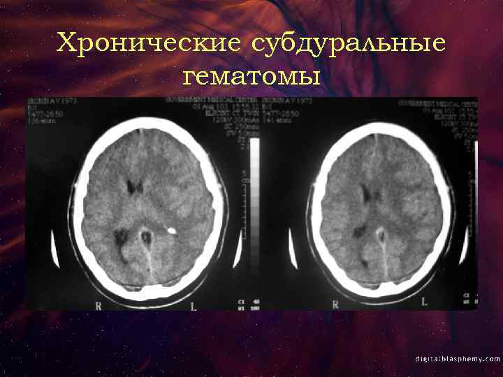 Хронические субдуральные гематомы 