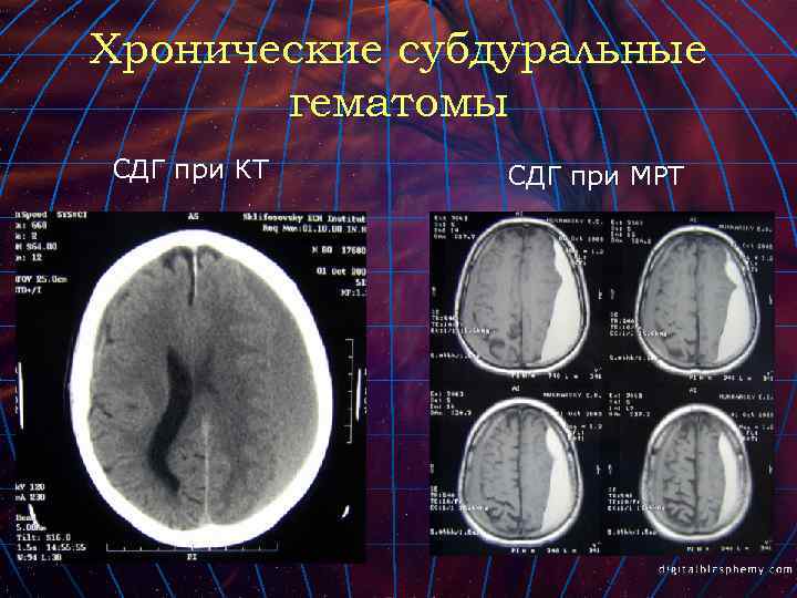 Хронические субдуральные гематомы СДГ при КТ СДГ при МРТ 