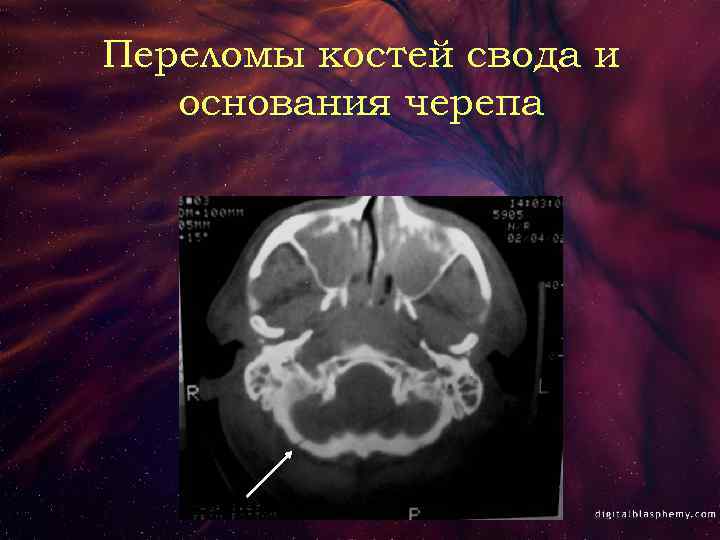 Переломы костей свода и основания черепа 