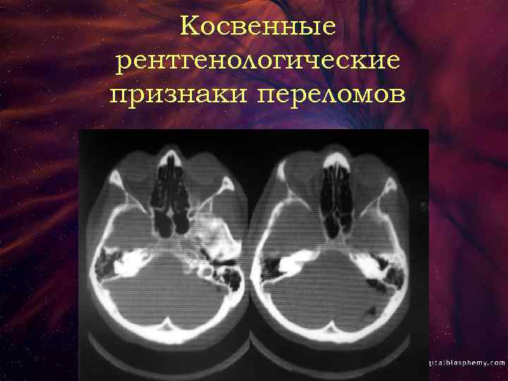 Косвенные рентгенологические признаки переломов 