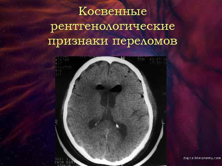 Косвенные рентгенологические признаки переломов 