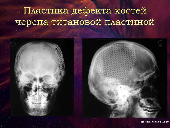 Пластика дефекта костей черепа титановой пластиной 