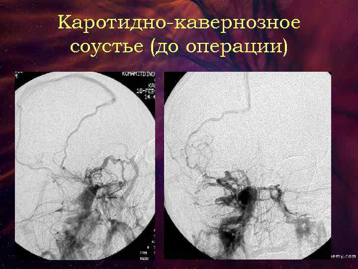 Каротидно-кавернозное соустье (до операции) 