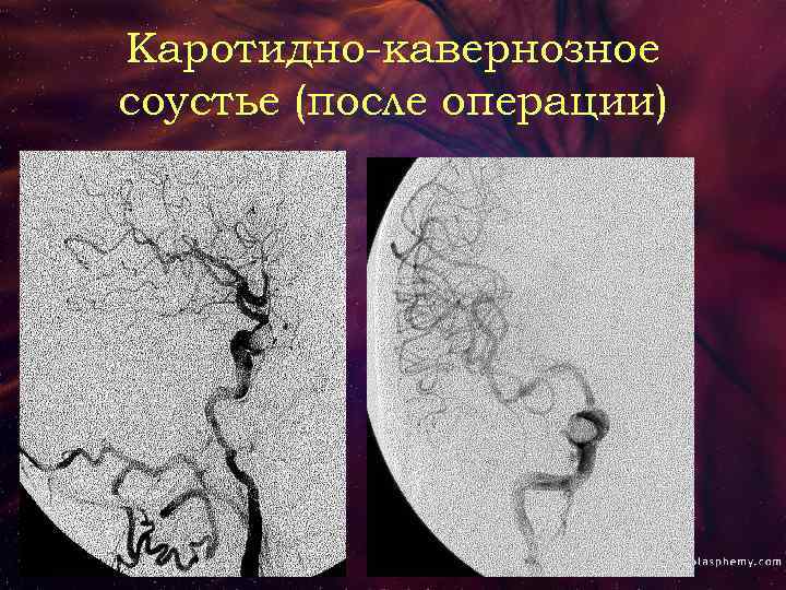 Каротидно-кавернозное соустье (после операции) 