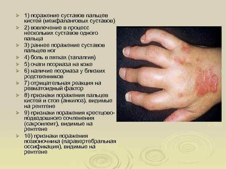 Ø Ø Ø Ø Ø 1) поражение суставов пальцев кистей (межфаланговых суставов) 2) вовлечение