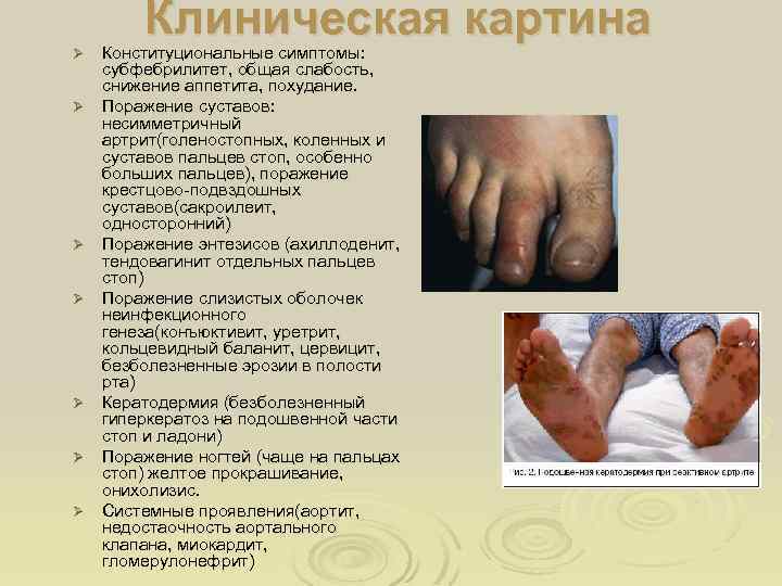 Ø Ø Ø Ø Клиническая картина Конституциональные симптомы: субфебрилитет, общая слабость, снижение аппетита, похудание.