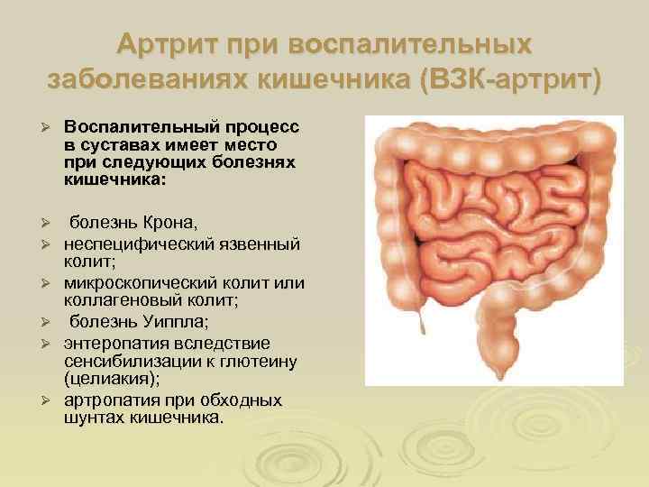 Артрит при воспалительных заболеваниях кишечника (ВЗК-артрит) Ø Воспалительный процесс в суставах имеет место при