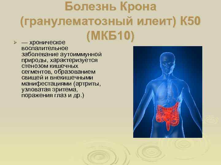 Эритема код по мкб 10. Серонегативный ревматоидный артрит мкб 10. Болезнь крона мкб 10 мкб. Серонегативный спондилоартрит мкб. Болезнь крона гранулематозный.