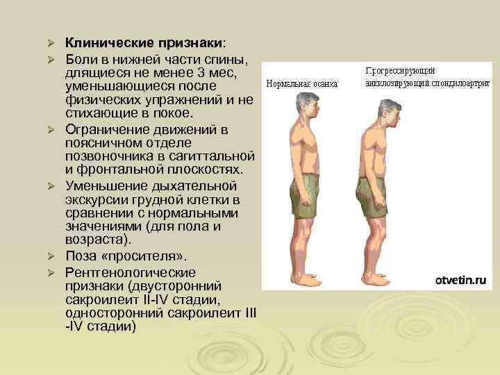 Ø Ø Ø Клинические признаки: Боли в нижней части спины, длящиеся не менее 3