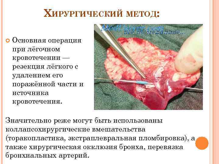 ХИРУРГИЧЕСКИЙ МЕТОД: Основная операция при лёгочном кровотечении — резекция лёгкого с удалением его поражённой