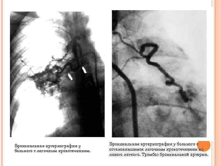 Бронхиальная артериография у больного с легочным кровотечением. Бронхиальная артериография у больного с остановившимся легочным