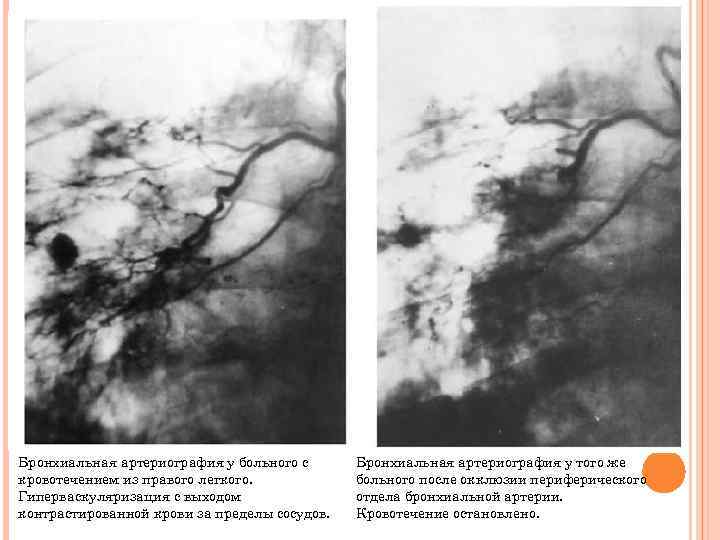 Бронхиальная артериография у больного с кровотечением из правого легкого. Гиперваскуляризация с выходом контрастированной крови