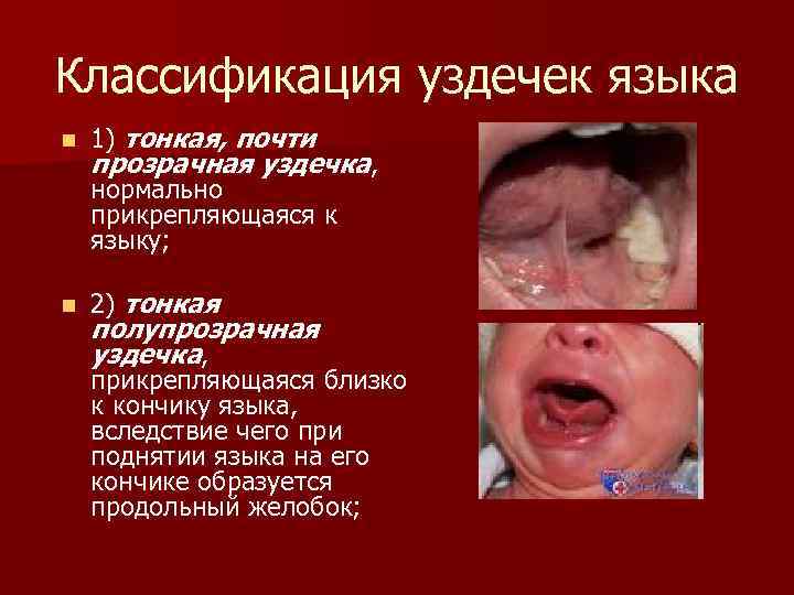 Классификация уздечек языка n 1) тонкая, почти прозрачная уздечка, нормально прикрепляющаяся к языку; n