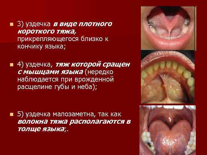 n 3) уздечка в виде плотного короткого тяжа, прикрепляющегося близко к кончику языка; n