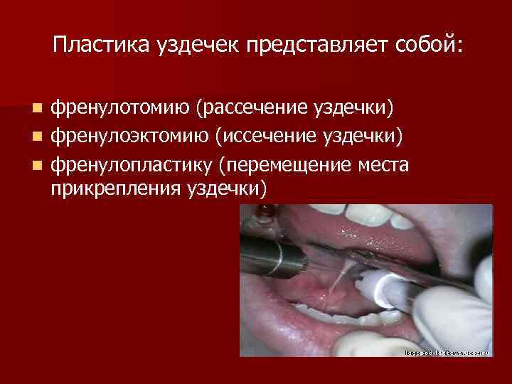 Пластика уздечек представляет собой: френулотомию (рассечение уздечки) n френулоэктомию (иссечение уздечки) n френулопластику (перемещение