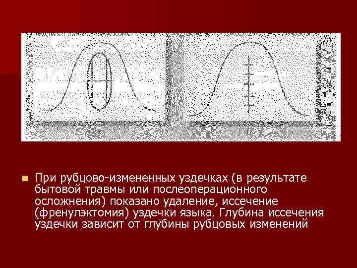 n При рубцово-измененных уздечках (в результате бытовой травмы или послеоперационного осложнения) показано удаление, иссечение