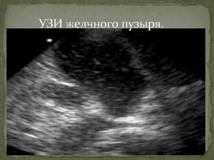 УЗИ желчного пузыря. 