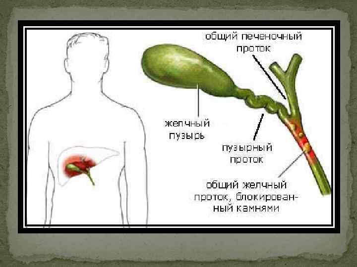 Лекция по теме Хронический холеоцистит