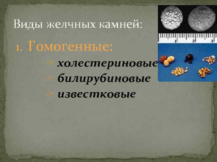 Виды желчных камней: 1. Гомогенные: ? холестериновые ? билирубиновые ? известковые 