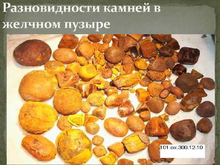 Разновидности камней в желчном пузыре 