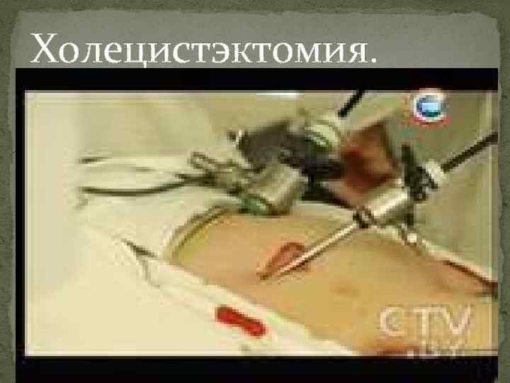 Холецистэктомия. 