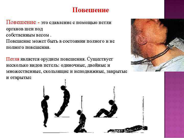 Повешение - это сдавление с помощью петли органов шеи под собственным весом. Повешение может