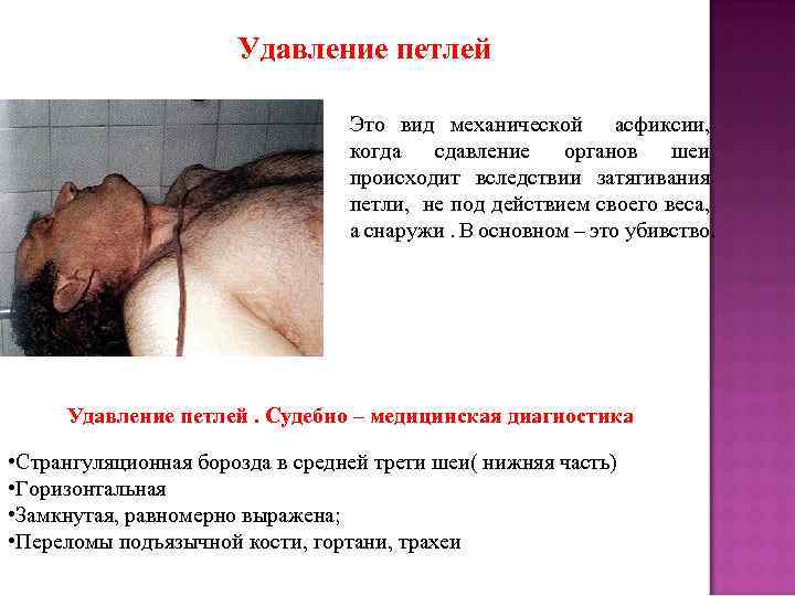 Удавление петлей Это вид механической асфиксии, когда сдавление органов шеи происходит вследствии затягивания петли,