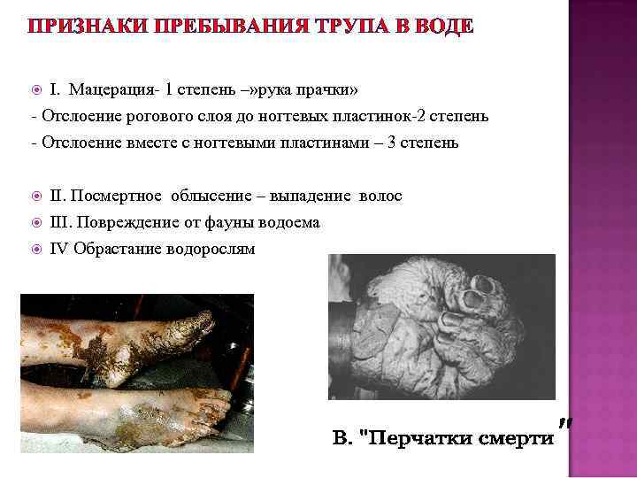 ПРИЗНАКИ ПРЕБЫВАНИЯ ТРУПА В ВОДЕ I. Мацерация- 1 степень –» рука прачки» - Отслоение