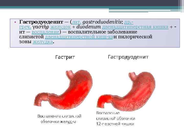 Гастродуоденит это