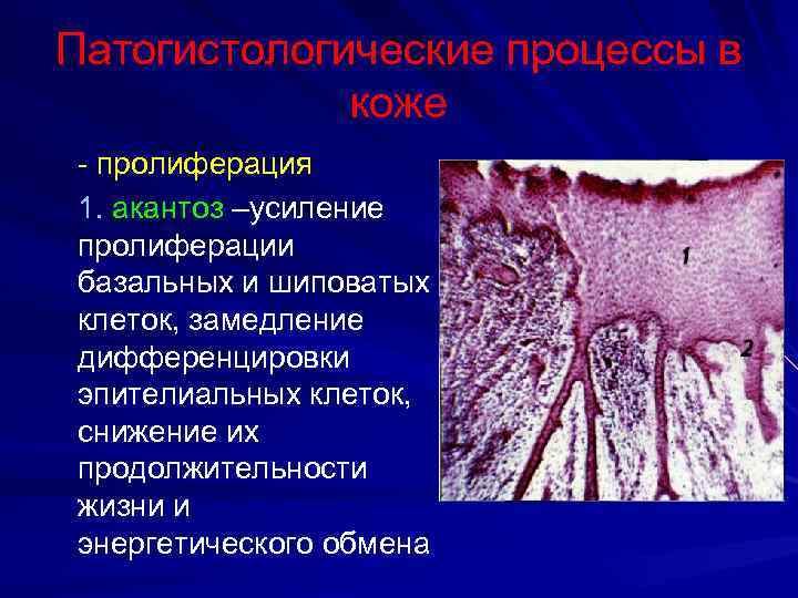 Патогистологические процессы в коже - пролиферация 1. акантоз –усиление пролиферации базальных и шиповатых клеток,